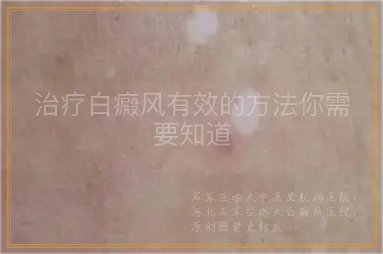 治疗白癜风有效的方法你需要知道