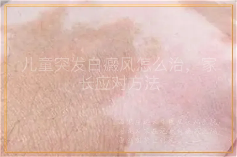 儿童突发白癜风怎么治，家长应对方法