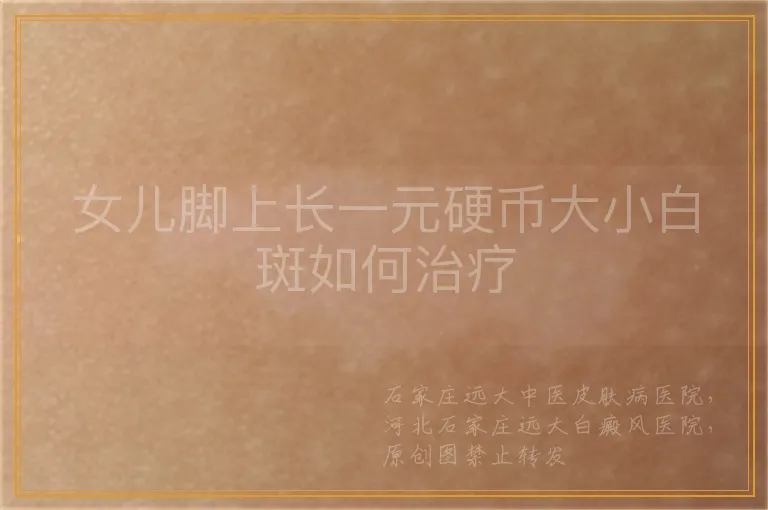 女儿脚上长一元硬币大小白斑如何治疗