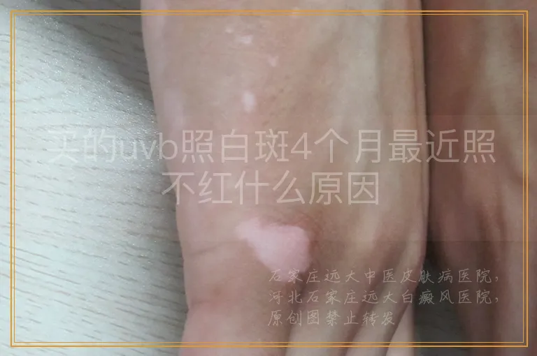 买的uvb照白斑4个月最近照不红什么原因