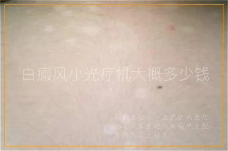 白癜风小光疗机大概多少钱