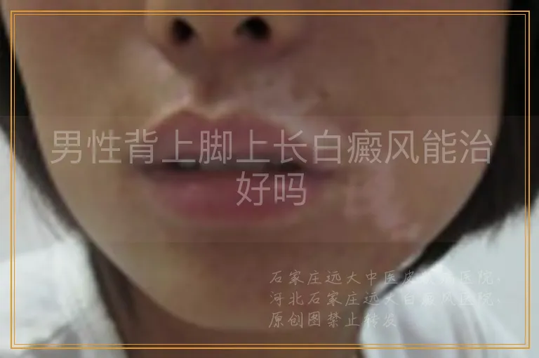 男性背上脚上长白癜风能治好吗