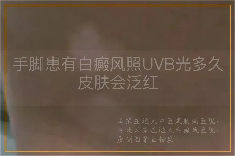 手脚患有白癜风照UVB光多久皮肤会泛红