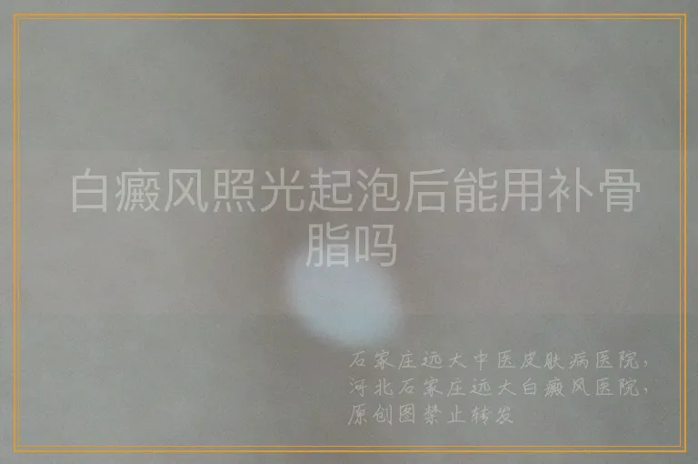 白癜风照光起泡后能用补骨脂吗