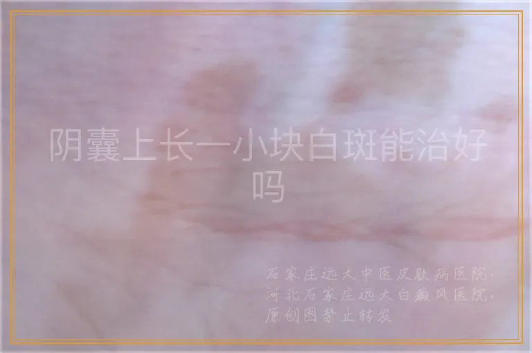 阴囊上长一小块白斑能治好吗