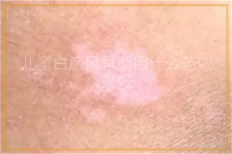 儿童白癜风早期用什么药效果好