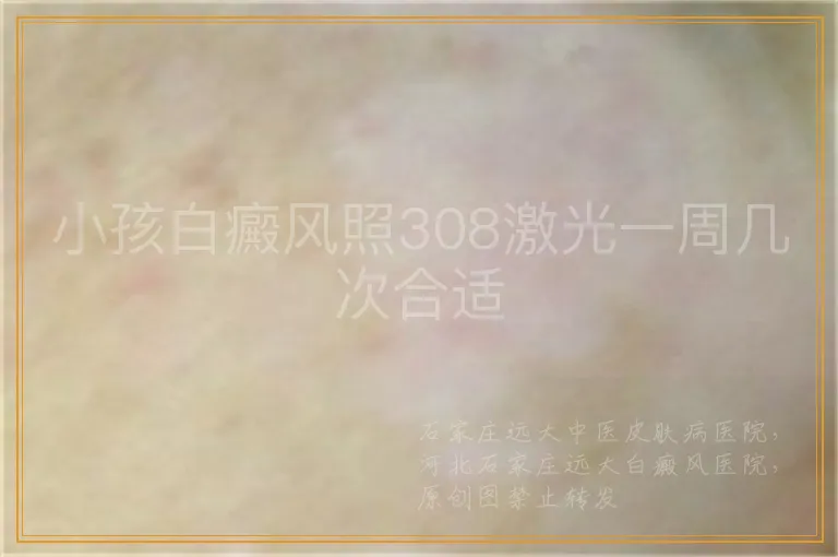 小孩白癜风照308激光一周几次合适