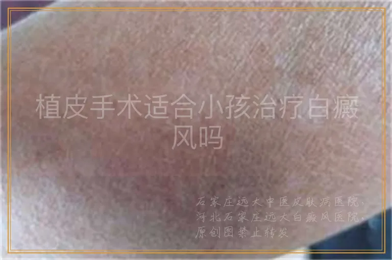 植皮手术适合小孩治疗白癜风吗