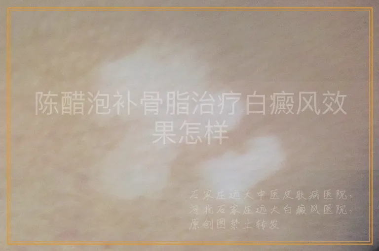 陈醋泡补骨脂治疗白癜风效果怎样