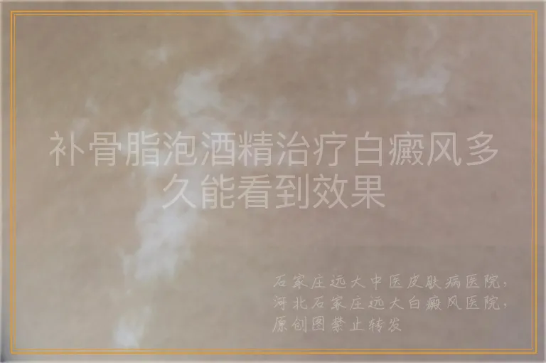 补骨脂泡酒精治疗白癜风多久能看到效果