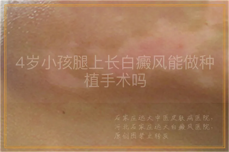 4岁小孩腿上长白癜风能做种植手术吗