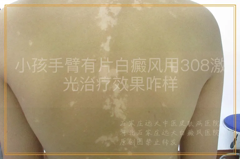 小孩手臂有片白癜风用308激光治疗效果咋样