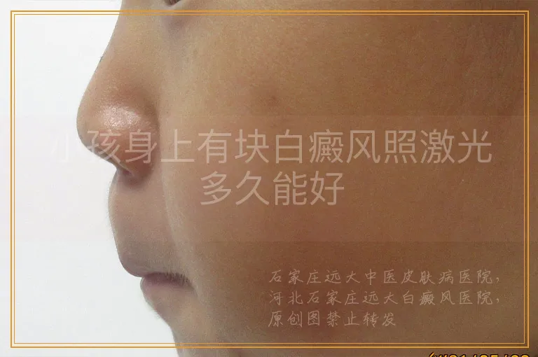 小孩身上有块白癜风照激光多久能好