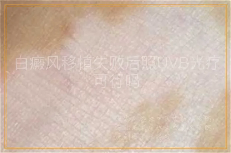 白癜风移植失败后照UVB光疗可行吗