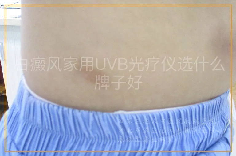 白癜风家用UVB光疗仪选什么牌子好