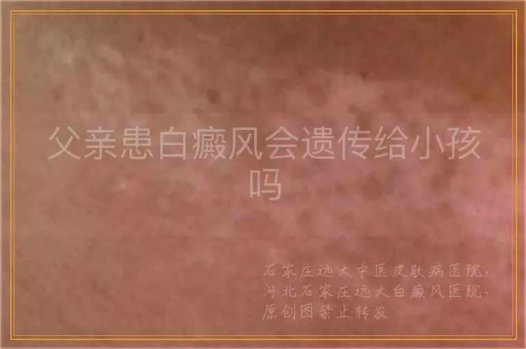 父亲患白癜风会遗传给小孩吗