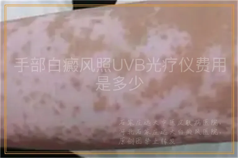 手部白癜风照UVB光疗仪费用是多少
