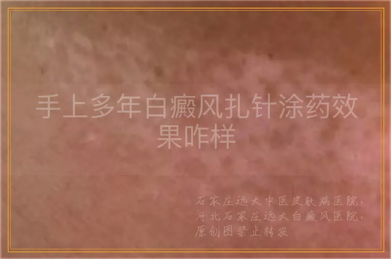 手上多年白癜风扎针涂药效果咋样