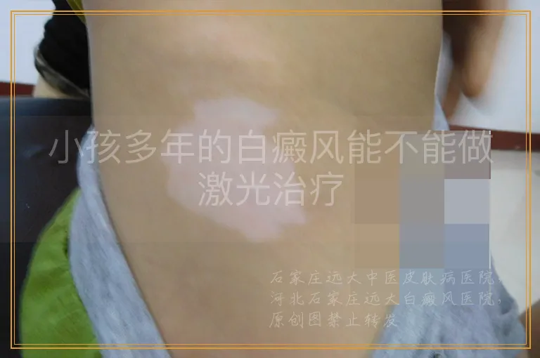 小孩多年的白癜风能不能做激光治疗