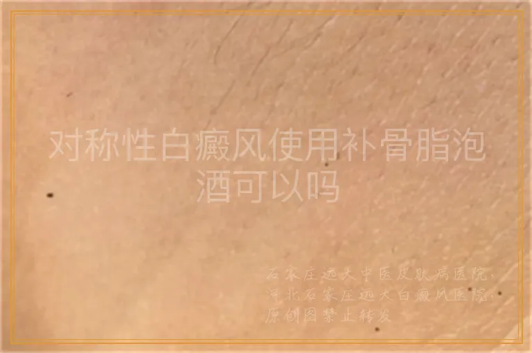 对称性白癜风使用补骨脂泡酒可以吗
