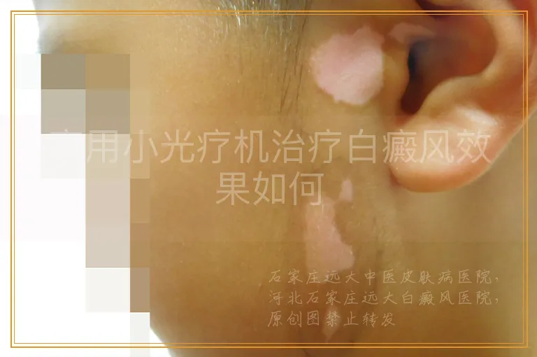 家用小光疗机治疗白癜风效果如何