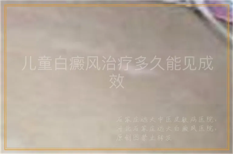 儿童白癜风治疗多久能见成效