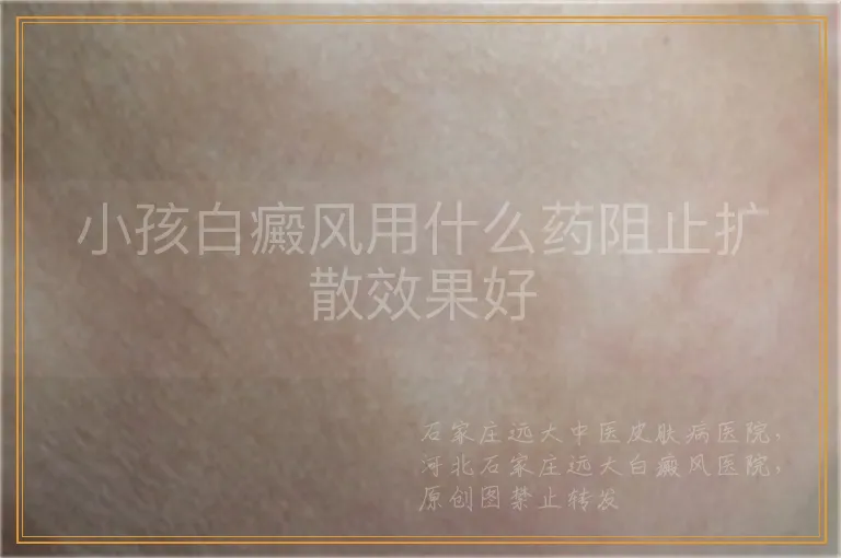 小孩白癜风用什么药阻止扩散效果好