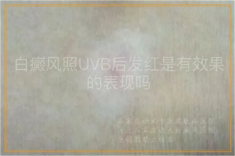 白癜风照UVB后发红是有效果的表现吗