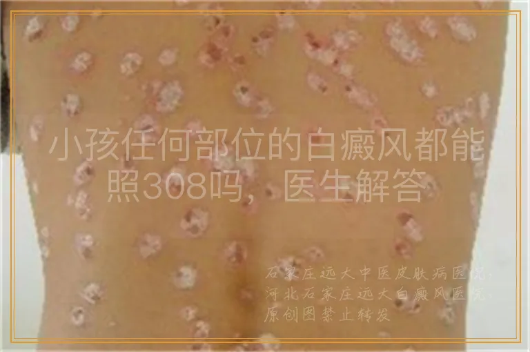 小孩任何部位的白癜风都能照308吗，医生解答