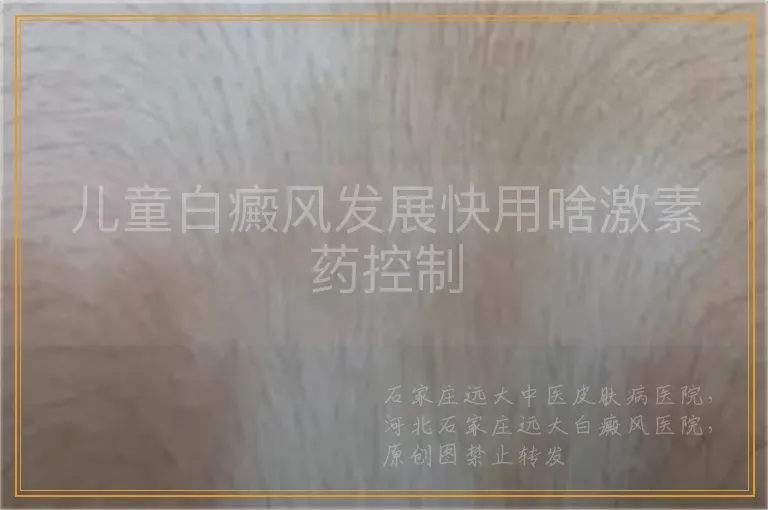 儿童白癜风发展快用啥激素药控制