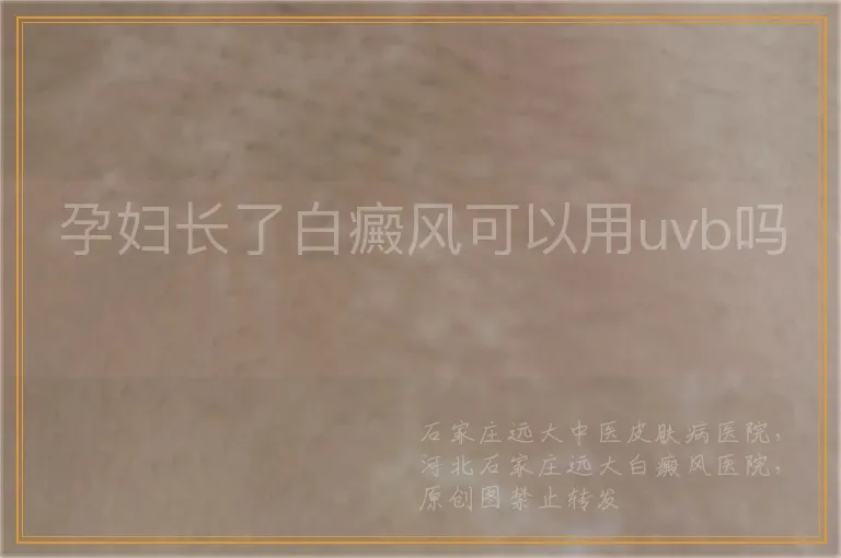 孕妇长了白癜风可以用uvb吗