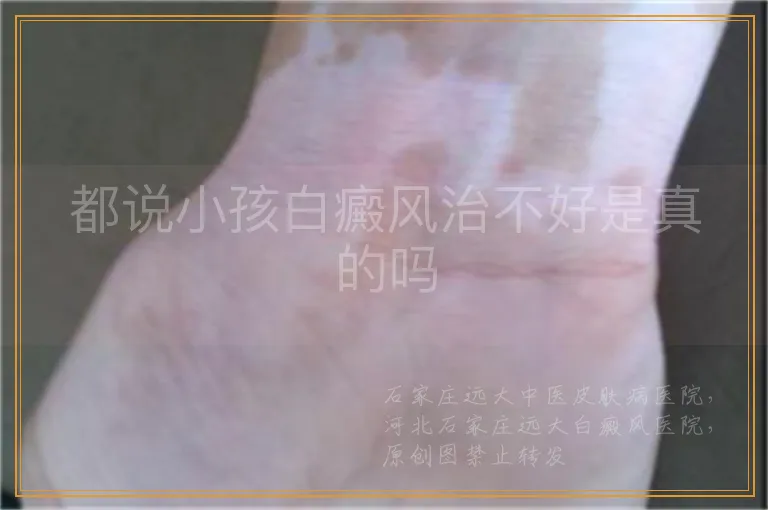 都说小孩白癜风治不好是真的吗