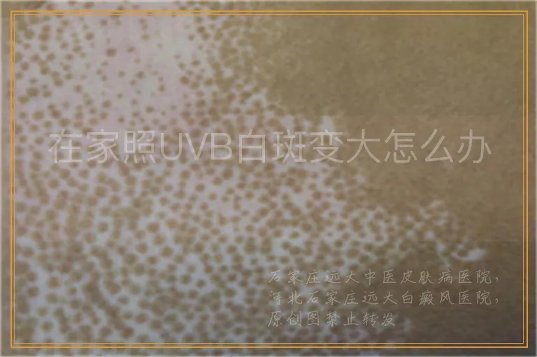在家照UVB白斑变大怎么办