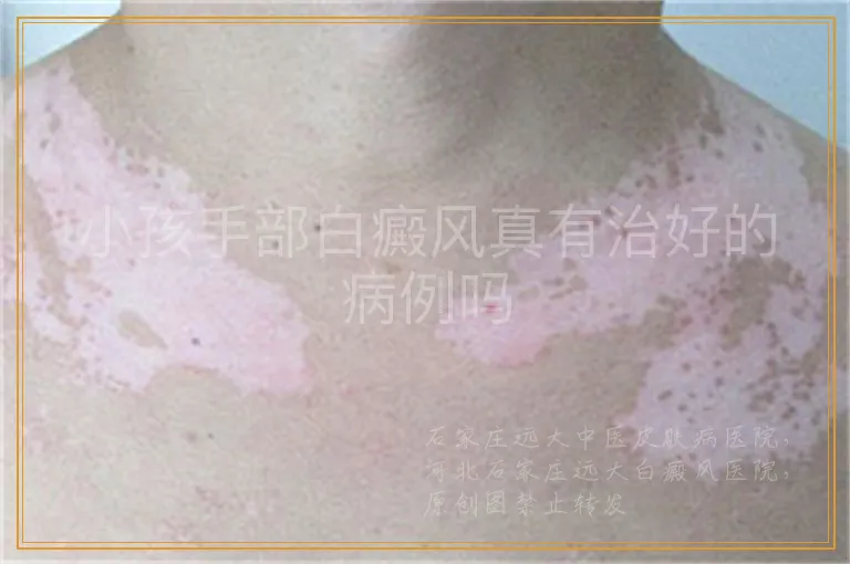 小孩手部白癜风真有治好的病例吗