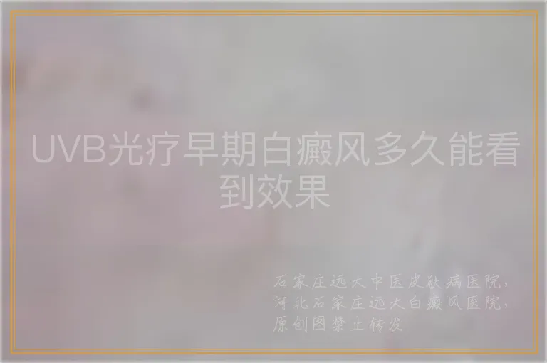 UVB光疗早期白癜风多久能看到效果
