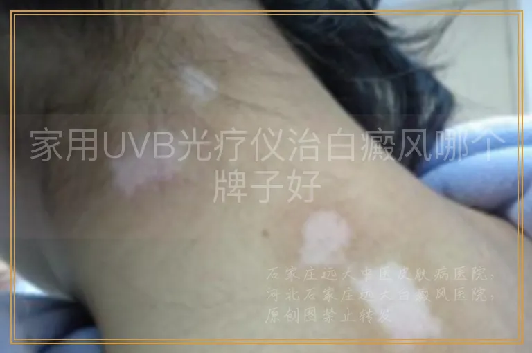 家用UVB光疗仪治白癜风哪个牌子好