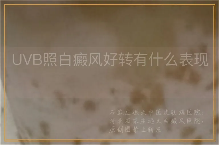 UVB照白癜风好转有什么表现