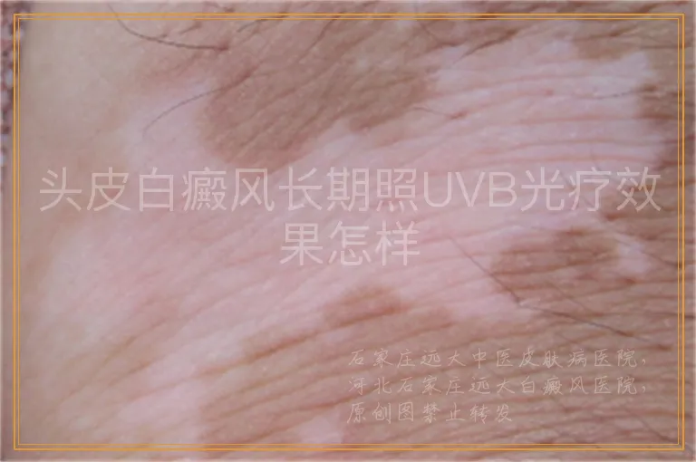 头皮白癜风长期照UVB光疗效果怎样