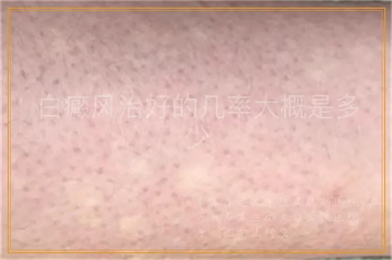 白癜风治好的几率大概是多少