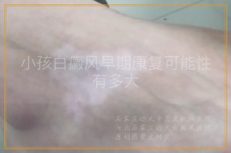 小孩白癜风早期康复可能性有多大