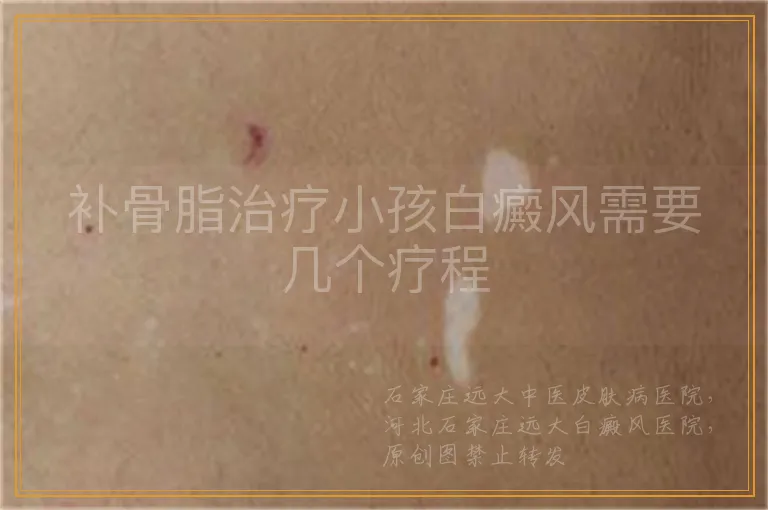 补骨脂治疗小孩白癜风需要几个疗程