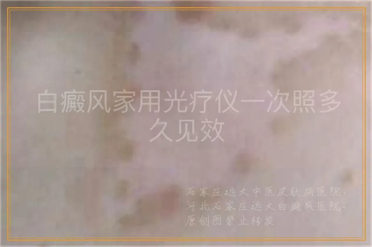 白癜风家用光疗仪一次照多久见效