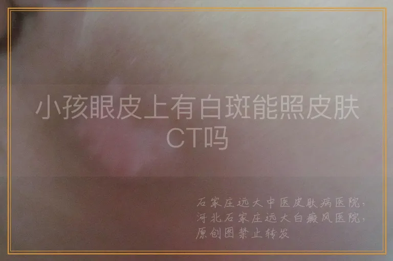 小孩眼皮上有白斑能照皮肤CT吗
