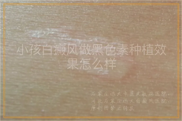 小孩白癜风做黑色素种植效果怎么样