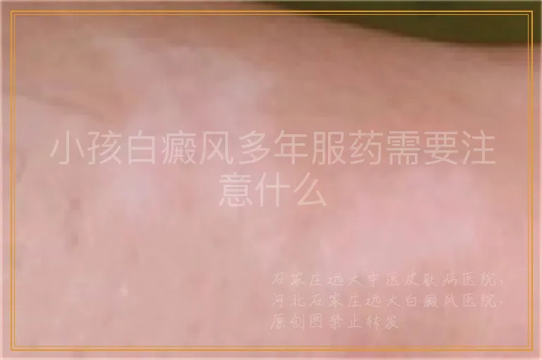 小孩白癜风多年服药需要注意什么