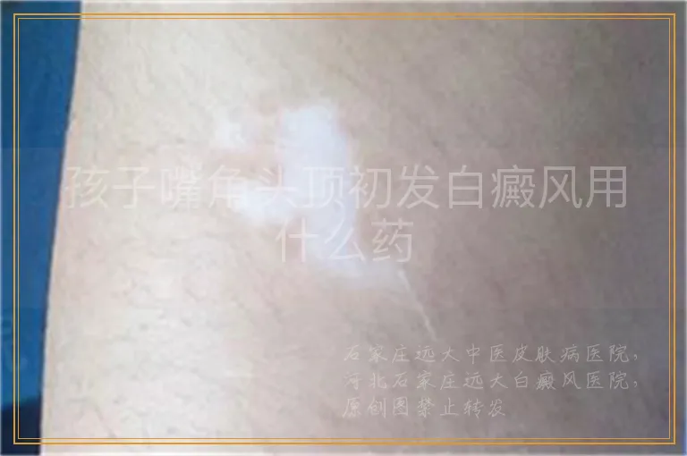 孩子嘴角头顶初发白癜风用什么药