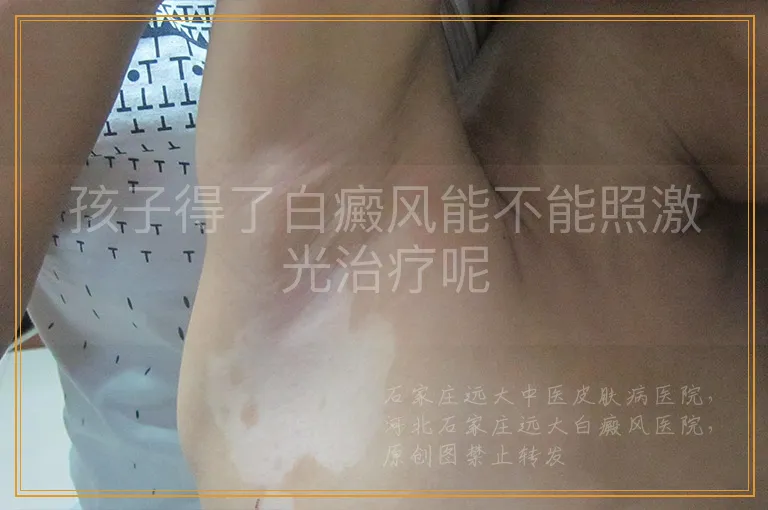 孩子得了白癜风能不能照激光治疗呢