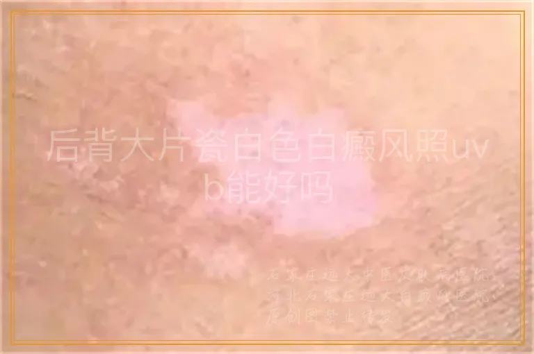 后背大片瓷白色白癜风照uvb能好吗