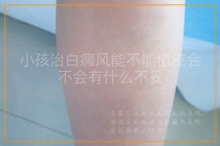 小孩治白癜风能不能植皮会不会有什么不妥