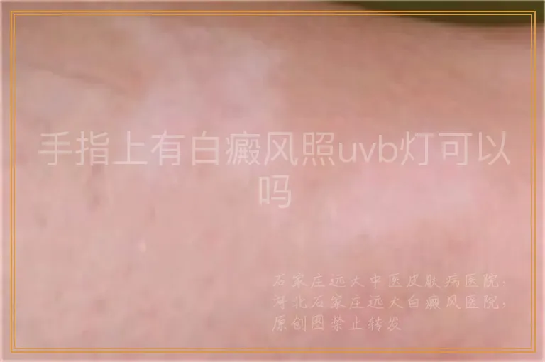 手指上有白癜风照uvb灯可以吗